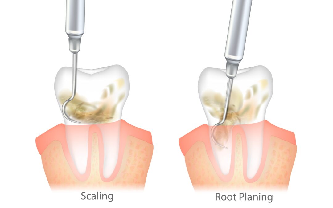 Difference of the Periodontal Scaling and Root Planing.